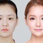 立拉美筋膜悬吊 非手术提拉塑形的抗衰新选择